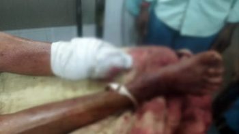 Rajasthan If the silver string did not open, the miscreants cut off the leg of the elderly