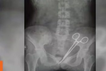 Surgical scissors remained in the patient's stomach for 12 years